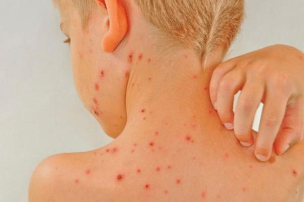 چگونه درمان آبله مرغان را آسان تر کنیم؟ چگونه درمان آبله مرغان را آسان تر کنیم؟